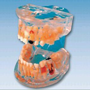 Transparent baby teeth pathological model